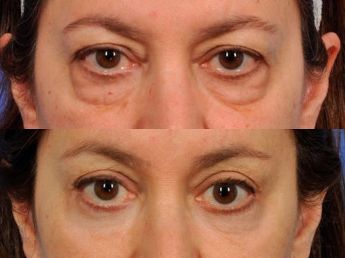 Blepharoplasty Before & After Gallery - Patient 407765 - Image 1
