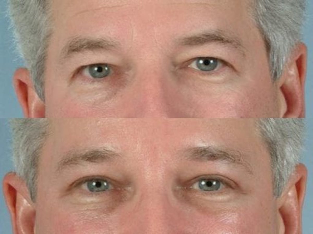 Blepharoplasty Before & After Gallery - Patient 153090 - Image 1