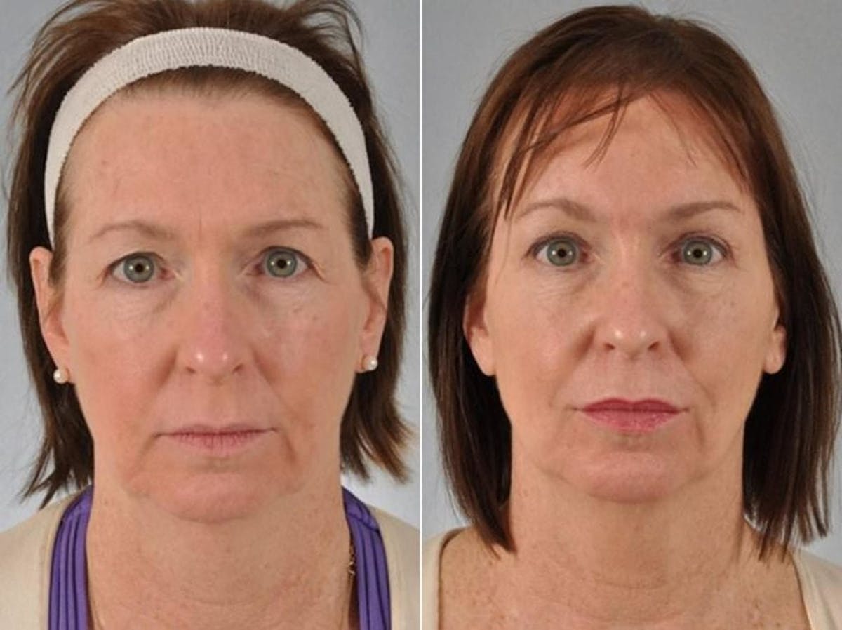 Blepharoplasty Before & After Gallery - Patient 601256 - Image 1