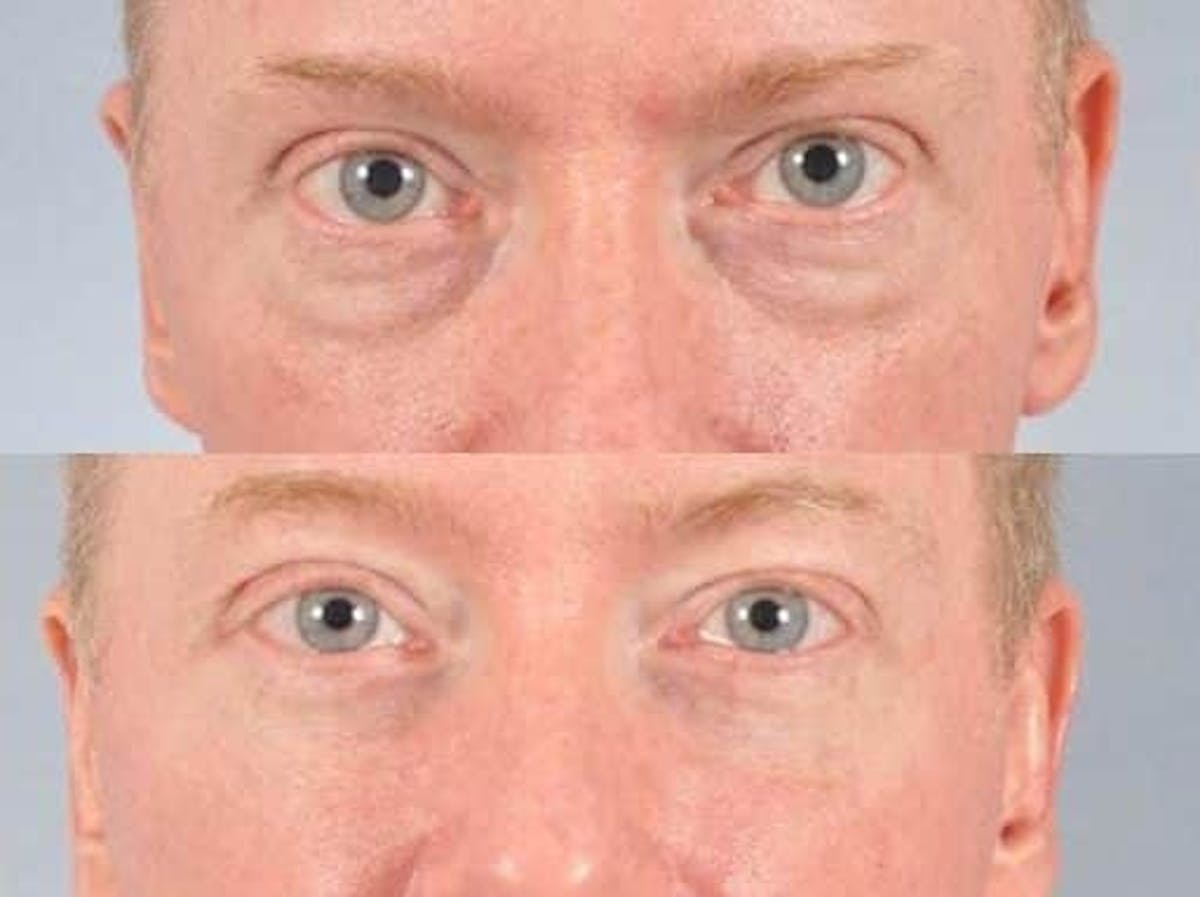 Blepharoplasty Before & After Gallery - Patient 193536 - Image 1
