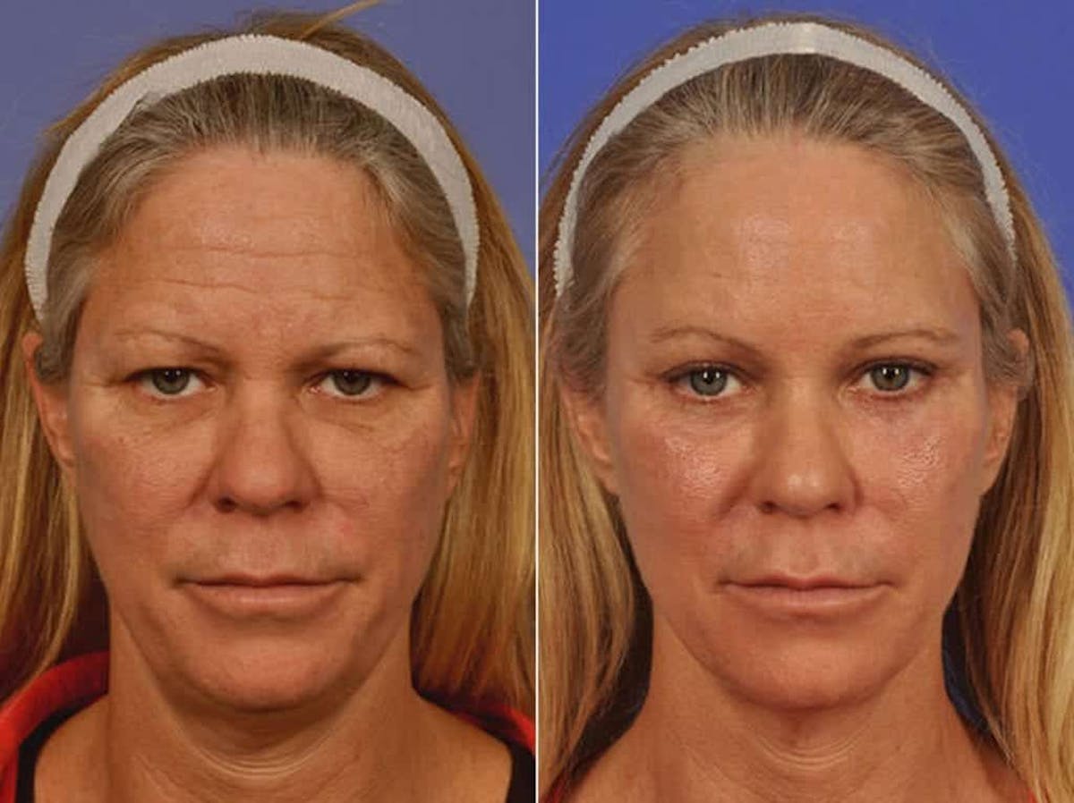 Blepharoplasty Before & After Gallery - Patient 297051 - Image 1