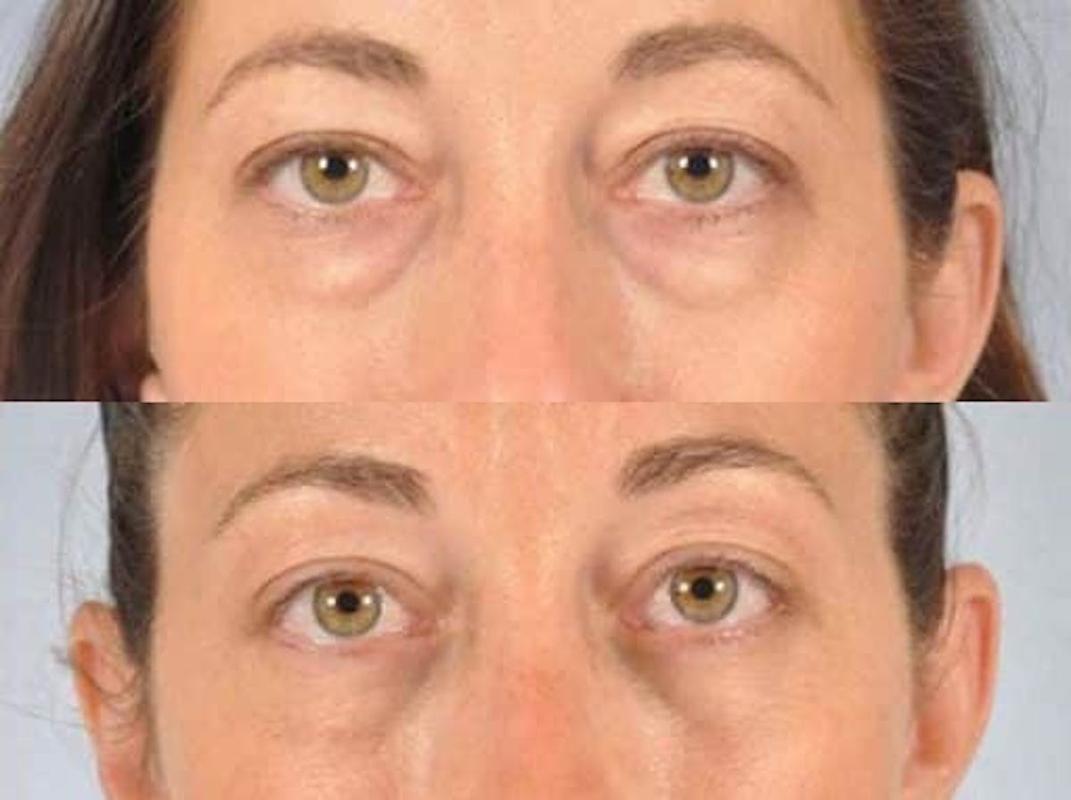 Blepharoplasty Before & After Gallery - Patient 213158 - Image 1