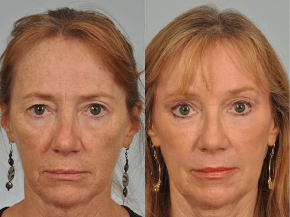 Blepharoplasty Before & After Gallery - Patient 476584 - Image 2