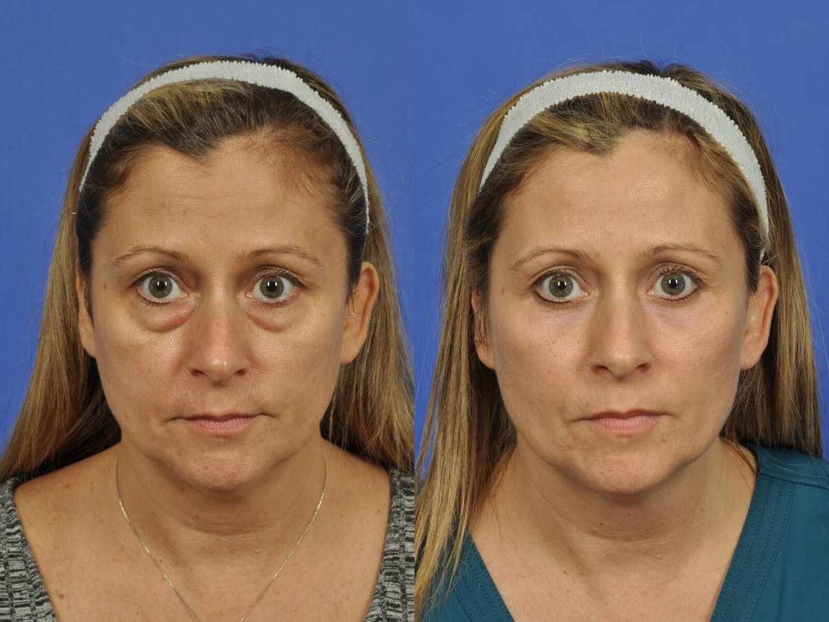 Blepharoplasty Before & After Gallery - Patient 100590 - Image 1