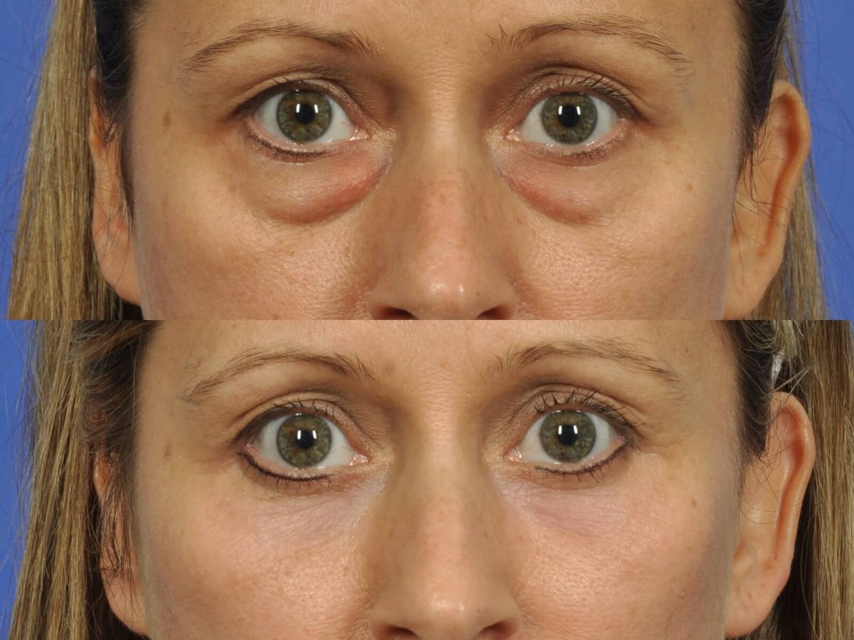 Blepharoplasty Before & After Gallery - Patient 100590 - Image 2