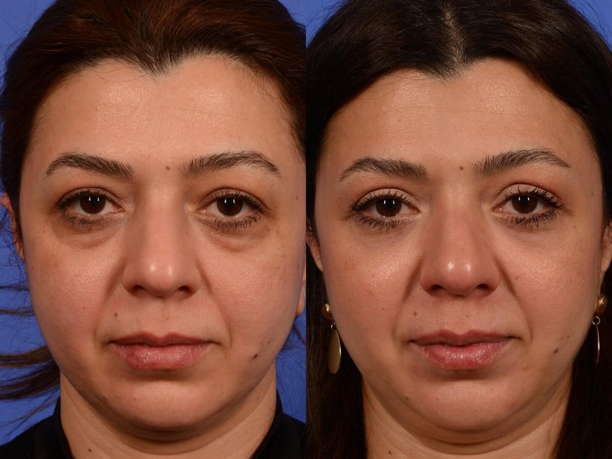 Blepharoplasty Before & After Gallery - Patient 266682 - Image 1