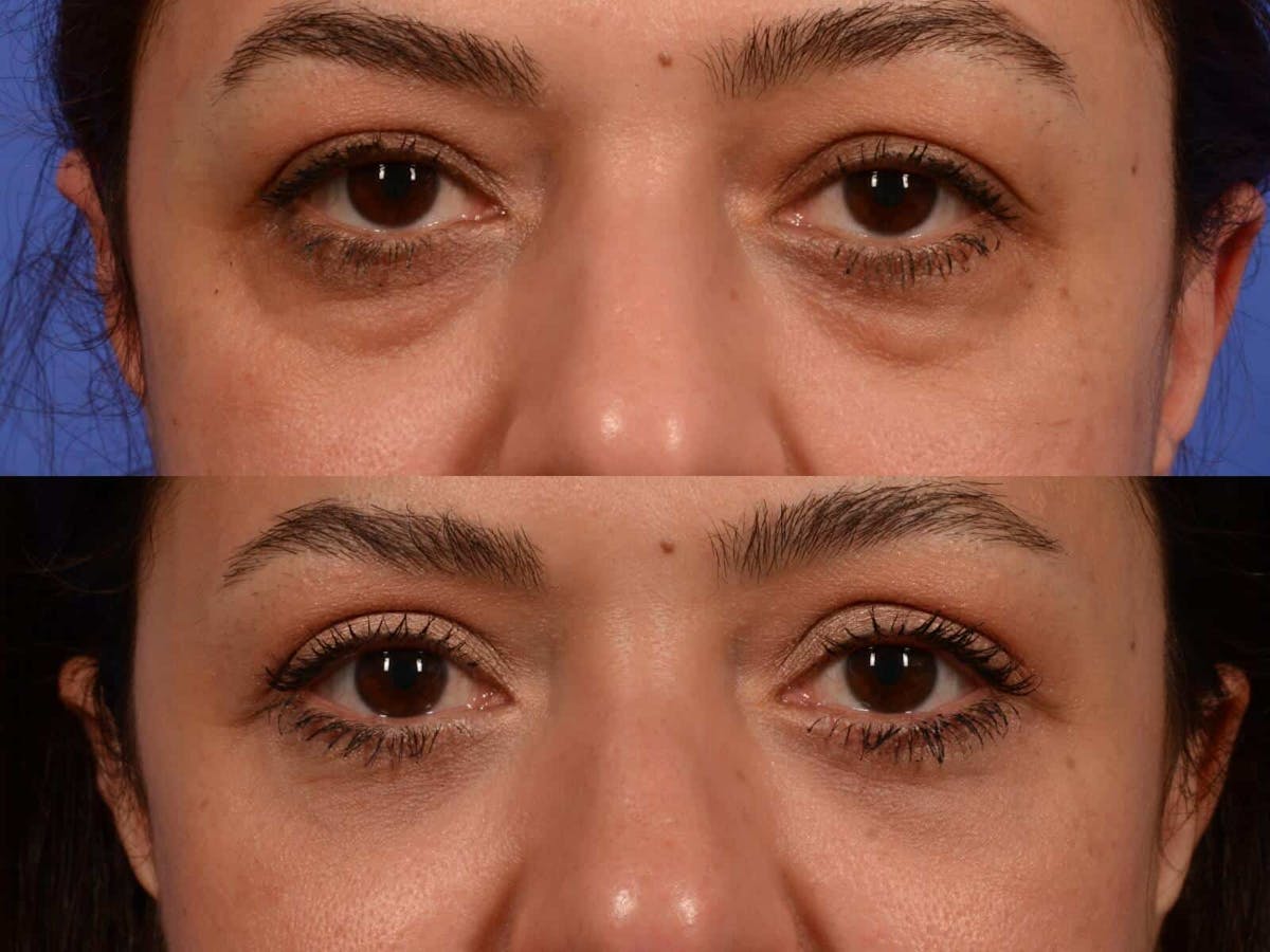 Blepharoplasty Before & After Gallery - Patient 266682 - Image 2