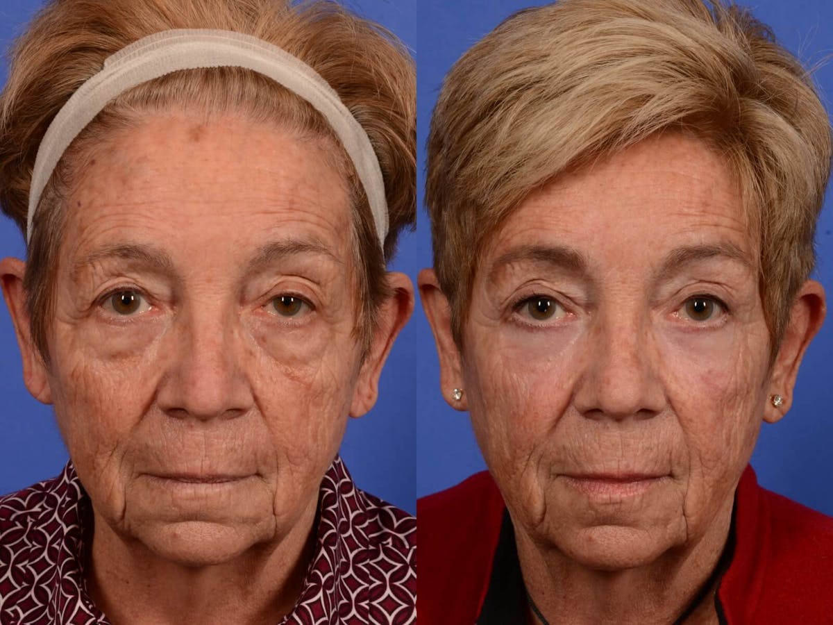 Blepharoplasty Before & After Gallery - Patient 129500 - Image 1