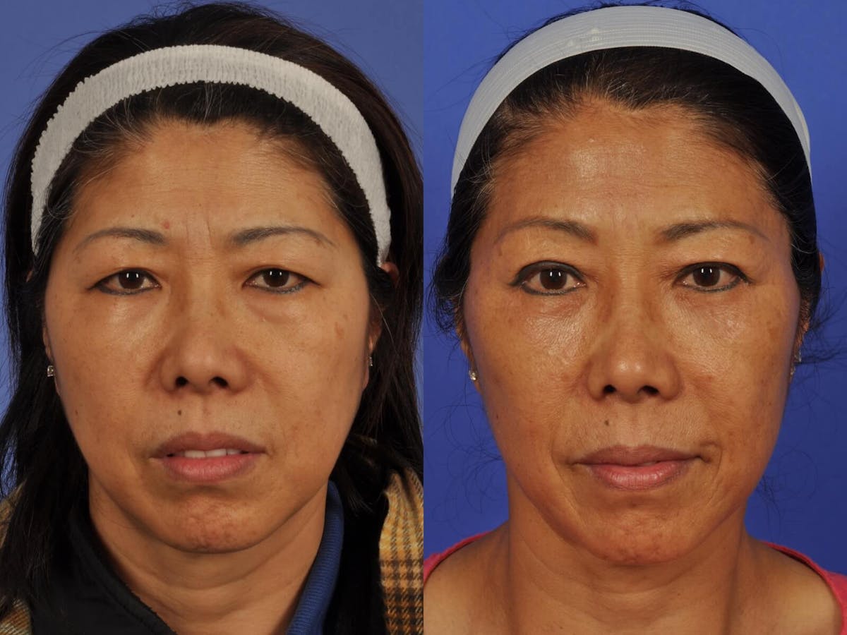 Blepharoplasty Before & After Gallery - Patient 335589 - Image 1