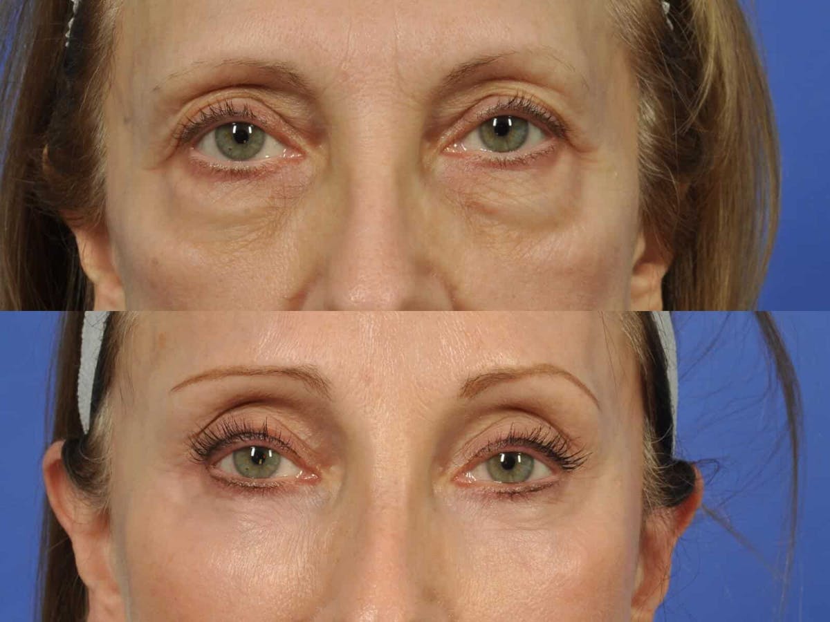 Blepharoplasty Before & After Gallery - Patient 149149 - Image 1