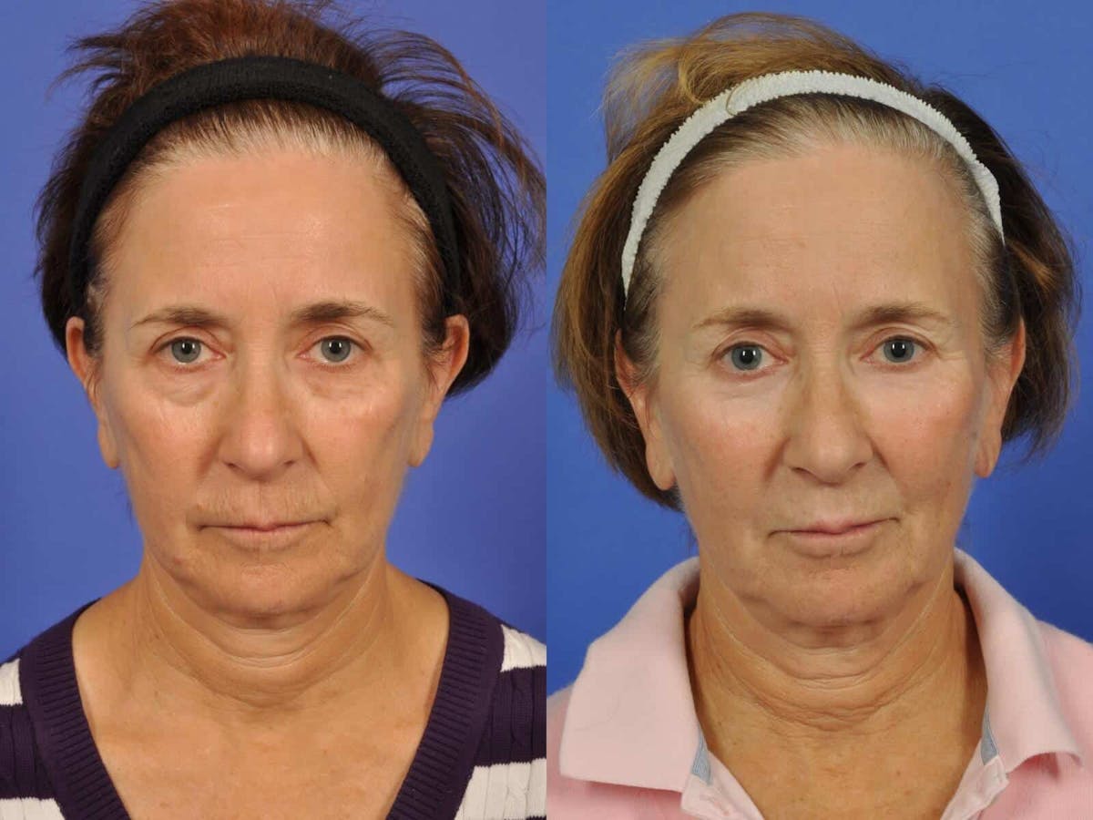 Blepharoplasty Before & After Gallery - Patient 355937 - Image 1