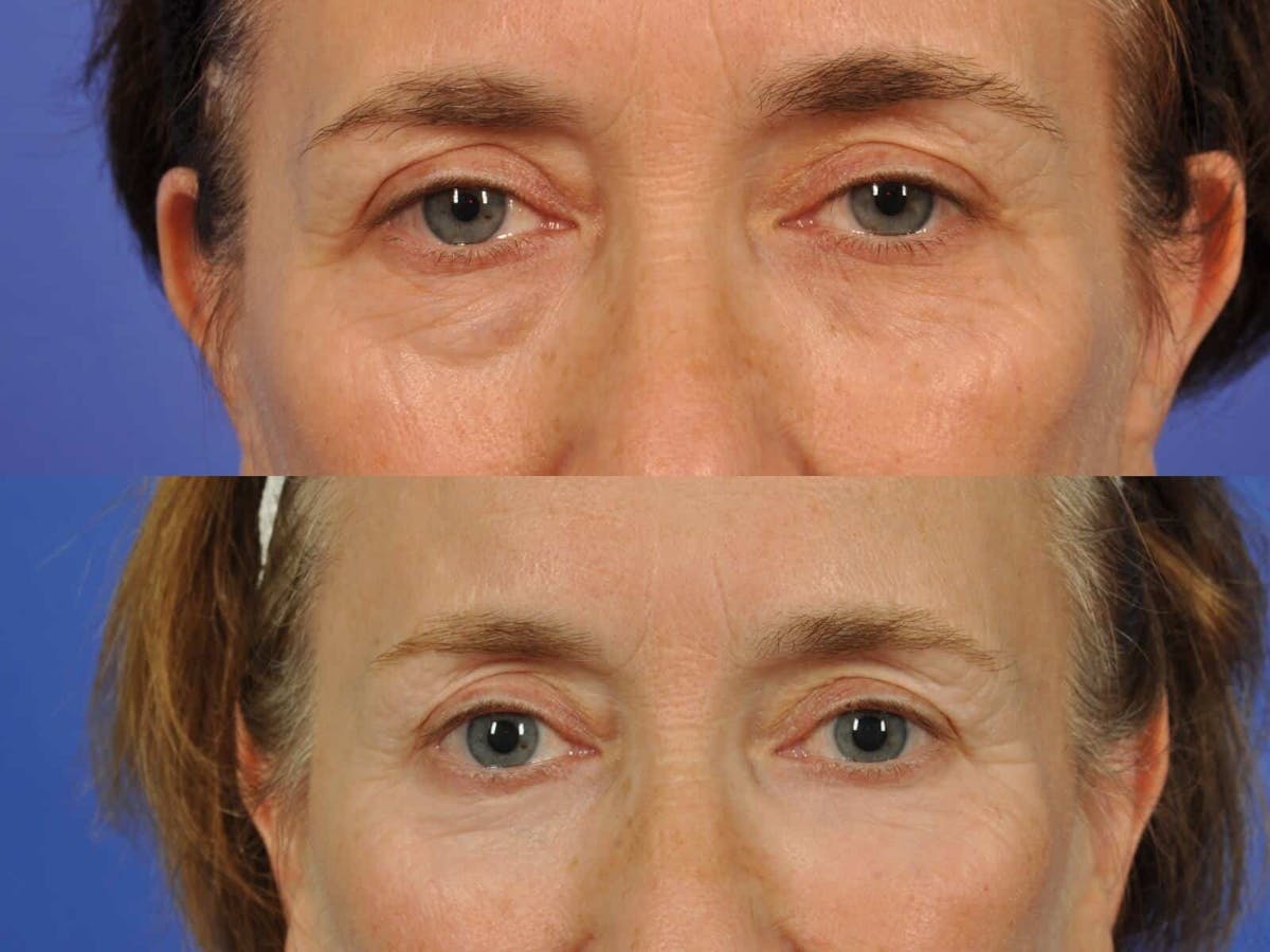 Blepharoplasty Before & After Gallery - Patient 355937 - Image 2