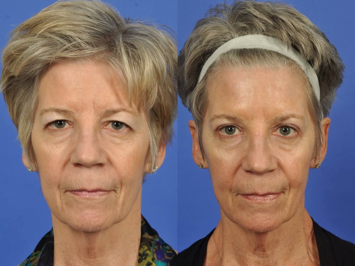 Blepharoplasty Before & After Gallery - Patient 198923 - Image 1