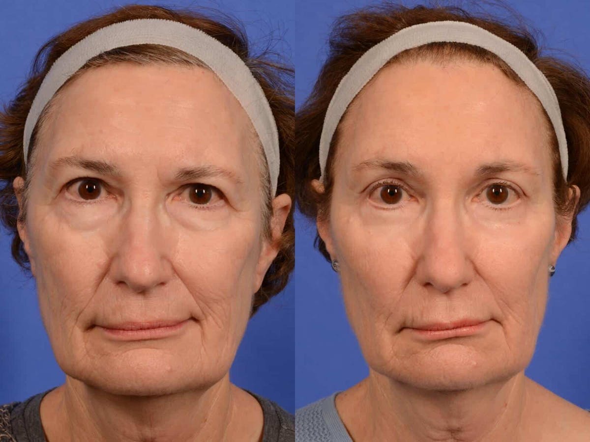 Blepharoplasty Before & After Gallery - Patient 896582 - Image 1