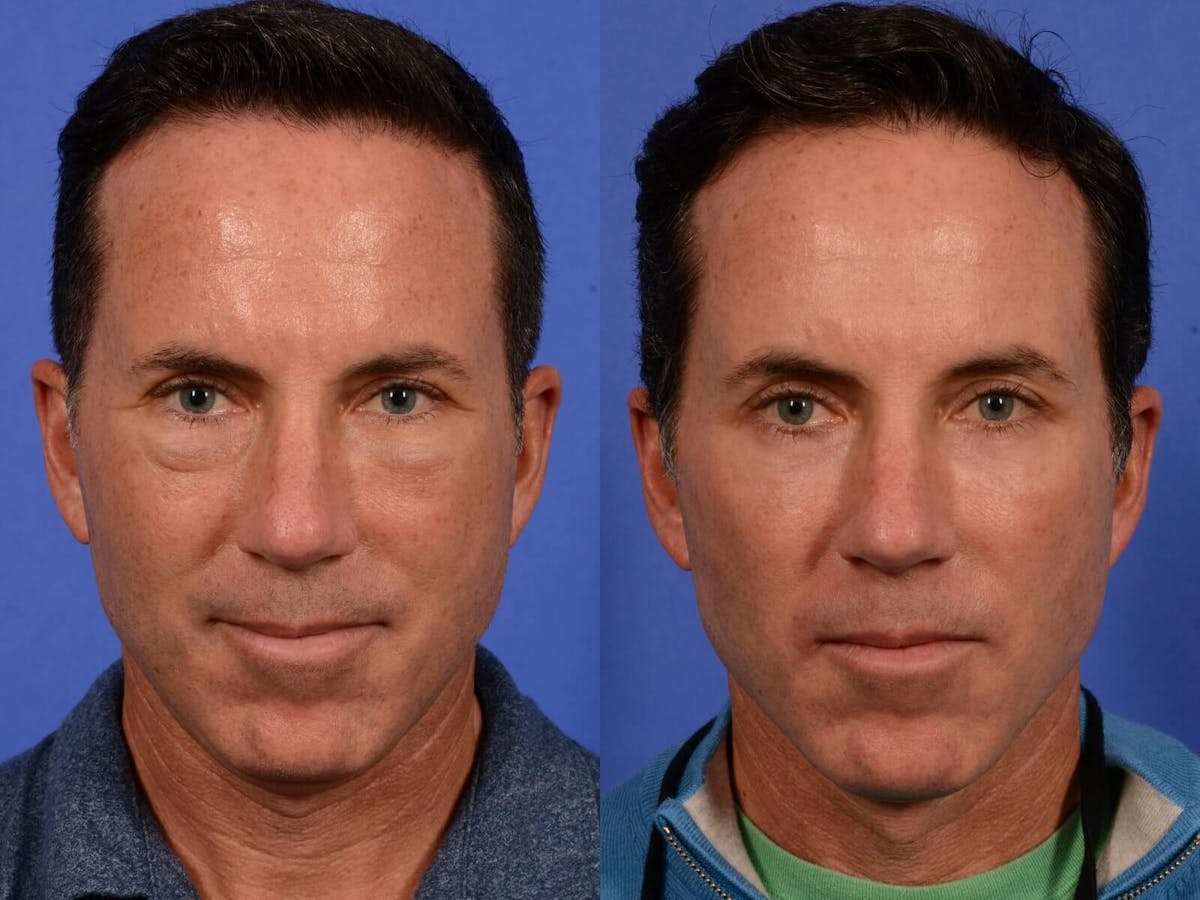Blepharoplasty Before & After Gallery - Patient 370675 - Image 1