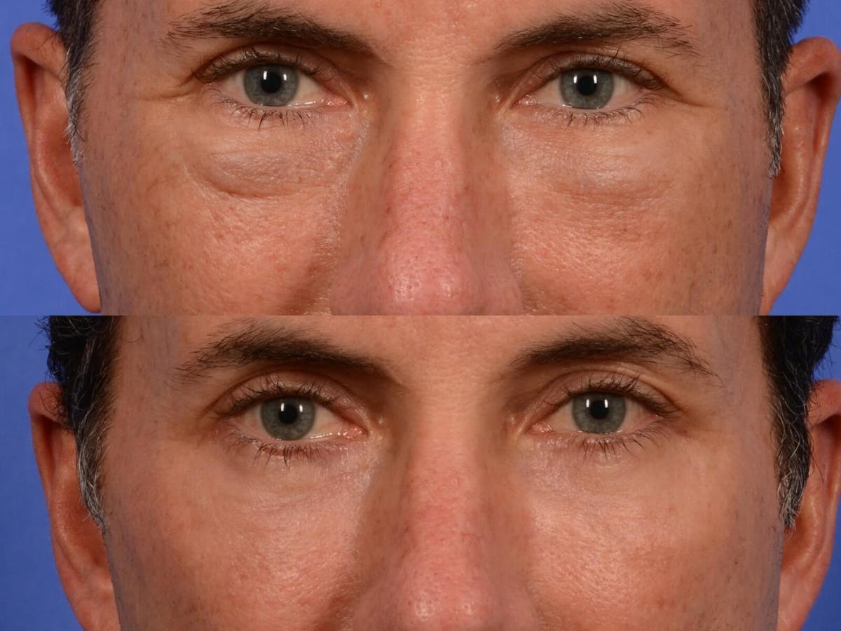Blepharoplasty Before & After Gallery - Patient 370675 - Image 2