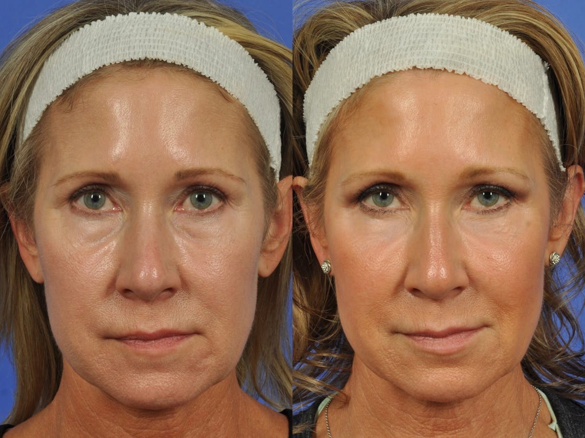 Blepharoplasty Before & After Gallery - Patient 241830 - Image 1