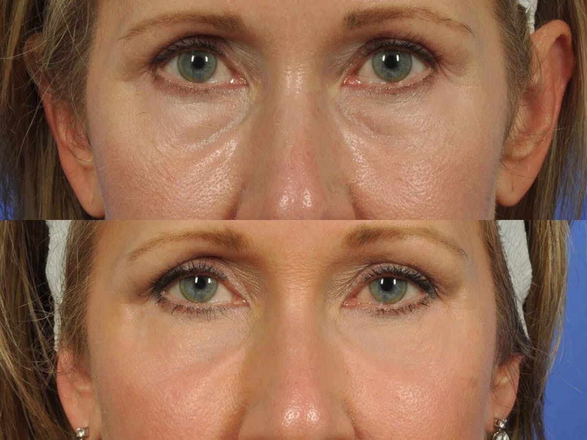 Blepharoplasty Before & After Gallery - Patient 241830 - Image 2