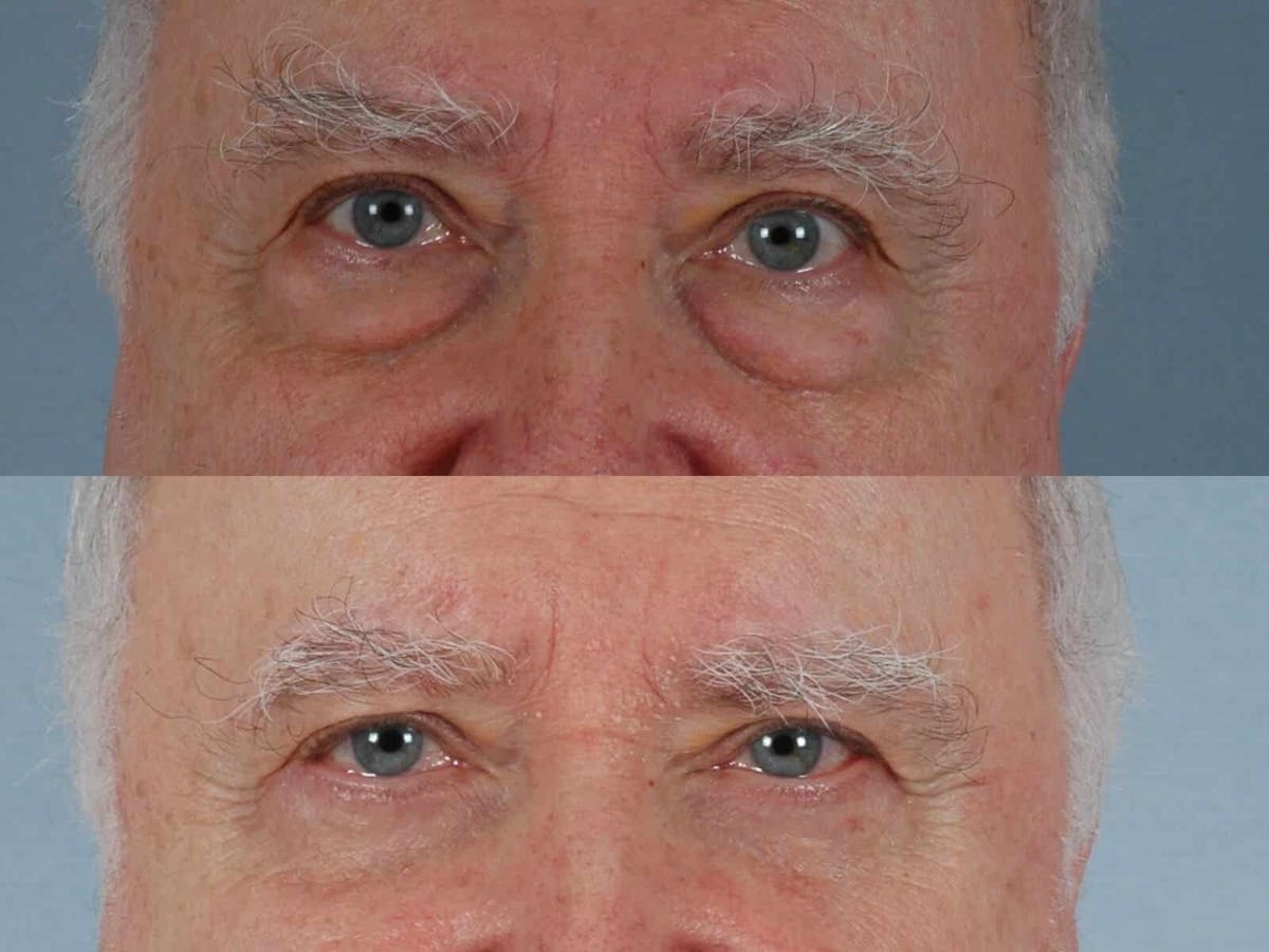 Blepharoplasty Before & After Gallery - Patient 391812 - Image 1