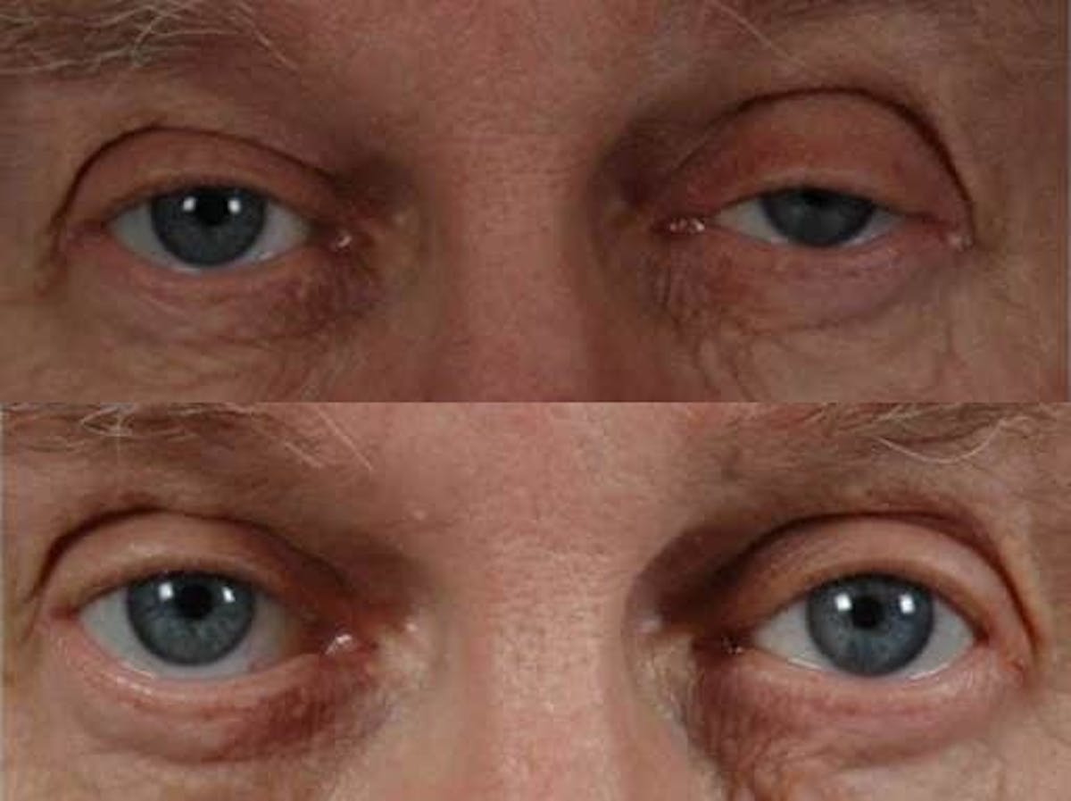 Droopy Eyelids – Ptosis Before & After Gallery - Patient 164755 - Image 1