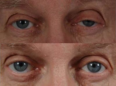 Droopy Eyelids – Ptosis Before & After Gallery - Patient 164755 - Image 1