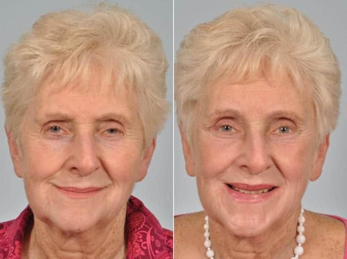 Droopy Eyelids – Ptosis Before & After Gallery - Patient 106912 - Image 1