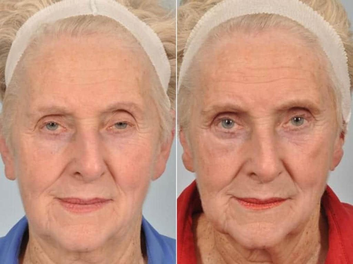 Droopy Eyelids – Ptosis Before & After Gallery - Patient 106912 - Image 2