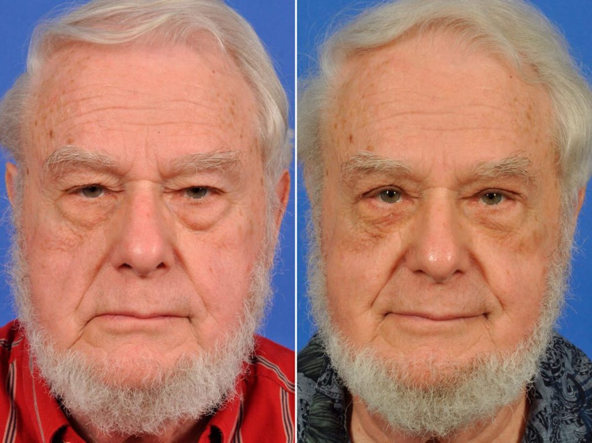Droopy Eyelids – Ptosis Before & After Gallery - Patient 273320 - Image 1