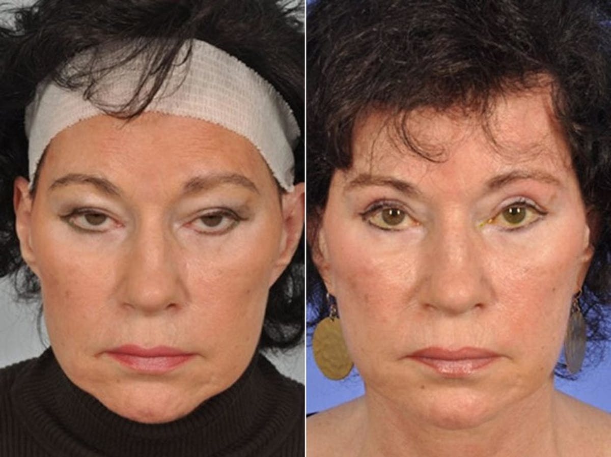 Droopy Eyelids – Ptosis Before & After Gallery - Patient 505730 - Image 1