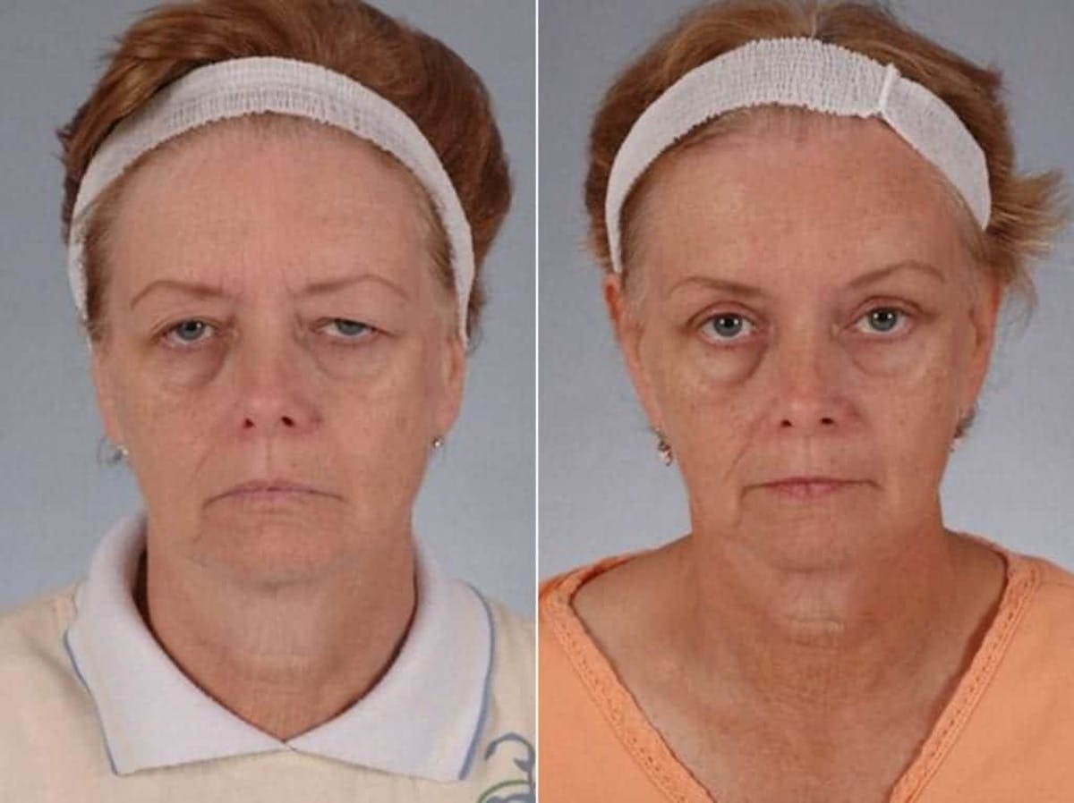 Droopy Eyelids – Ptosis Before & After Gallery - Patient 428369 - Image 1