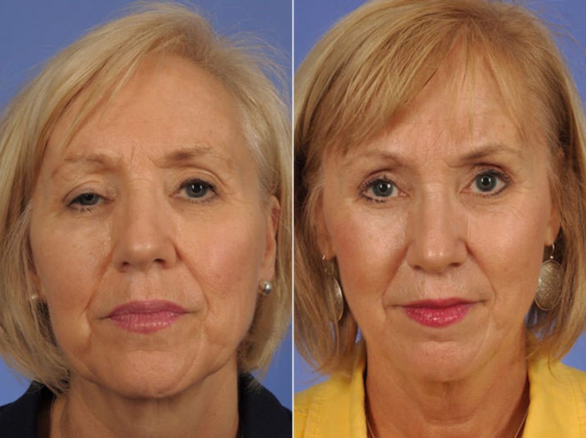 Droopy Eyelids – Ptosis Before & After Gallery - Patient 245463 - Image 1