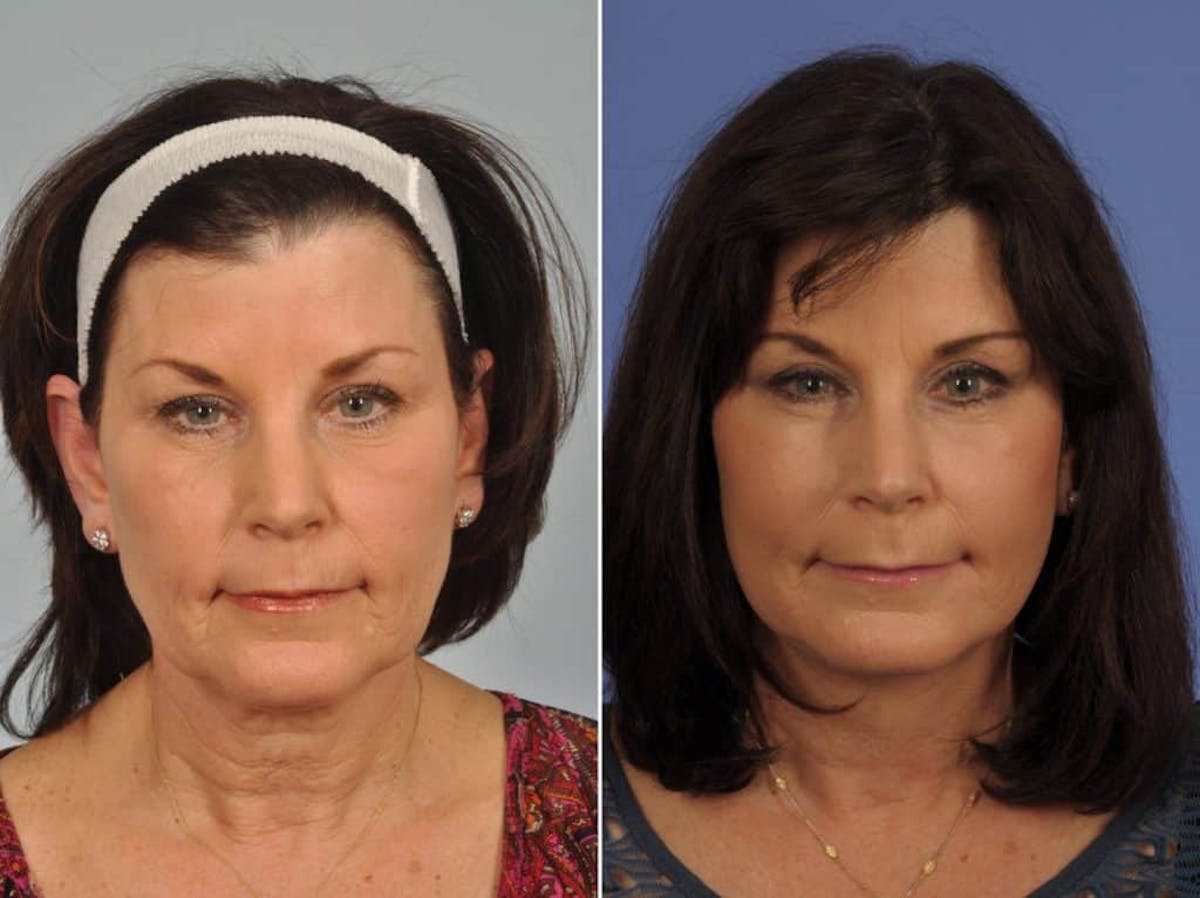 Droopy Eyelids – Ptosis Before & After Gallery - Patient 327512 - Image 1