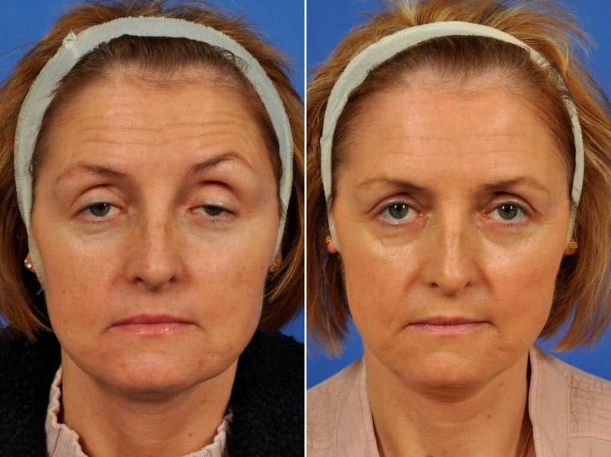 Droopy Eyelids – Ptosis Before & After Gallery - Patient 271731 - Image 1