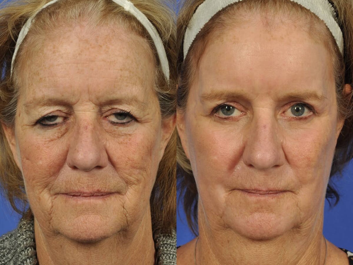 Droopy Eyelids – Ptosis Before & After Gallery - Patient 114011 - Image 1