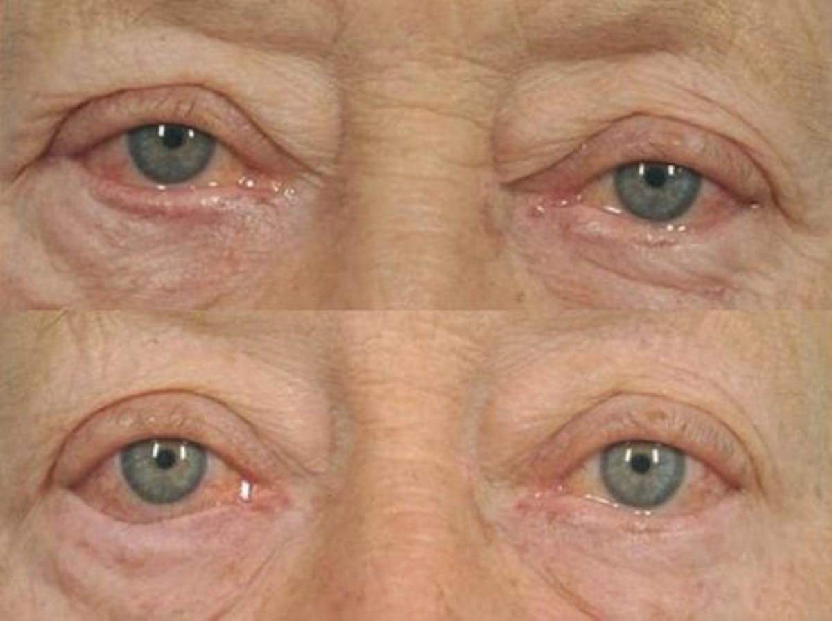 Droopy Eyelids – Ptosis Before & After Gallery - Patient 142578 - Image 1
