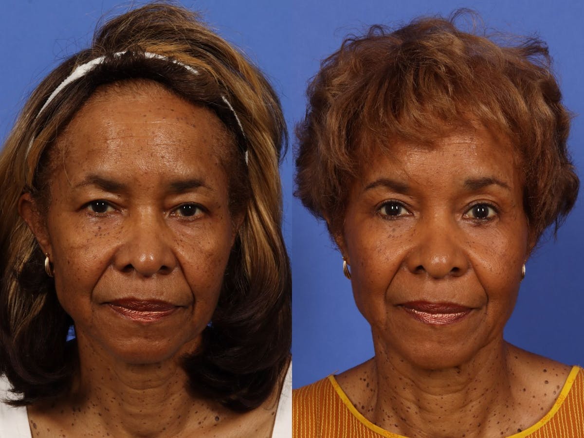 Festoon Surgery Before & After Gallery - Patient 367317 - Image 6