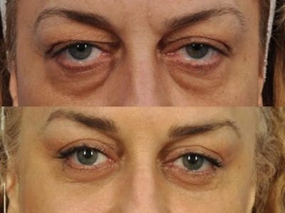 Festoon Surgery Before & After Gallery - Patient 105598 - Image 2