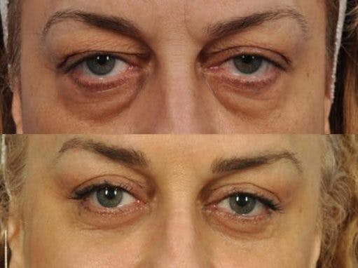 Festoon Surgery Before & After Gallery - Patient 105598 - Image 2