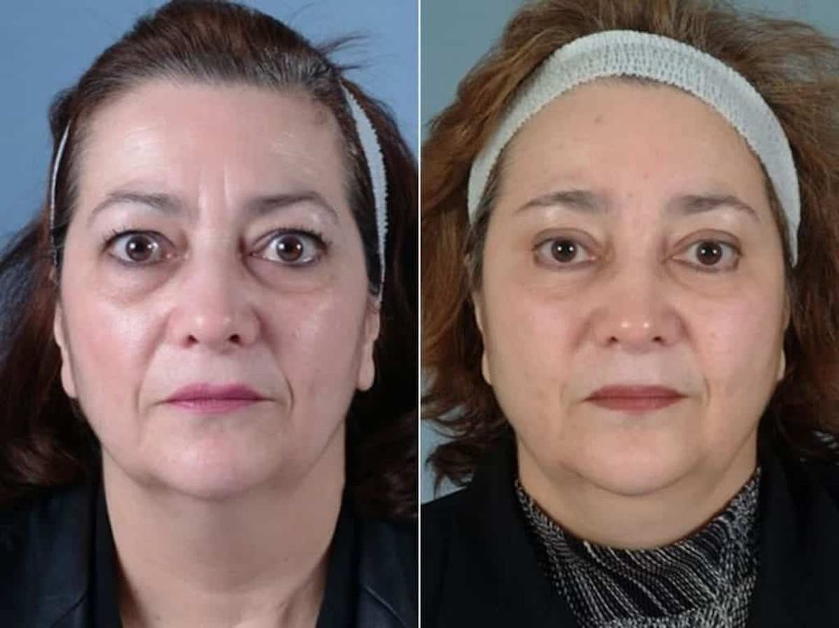 Thyroid Eye Disease Before & After Gallery - Patient 124202 - Image 1