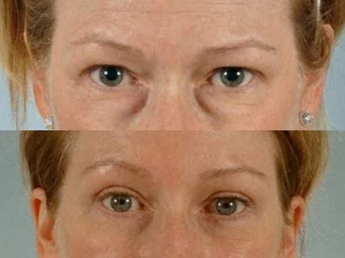 Thyroid Eye Disease Before & After Gallery - Patient 487248 - Image 1