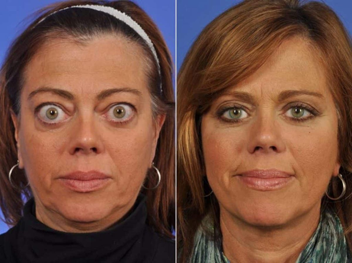 Thyroid Eye Disease Before & After Gallery - Patient 414080 - Image 1