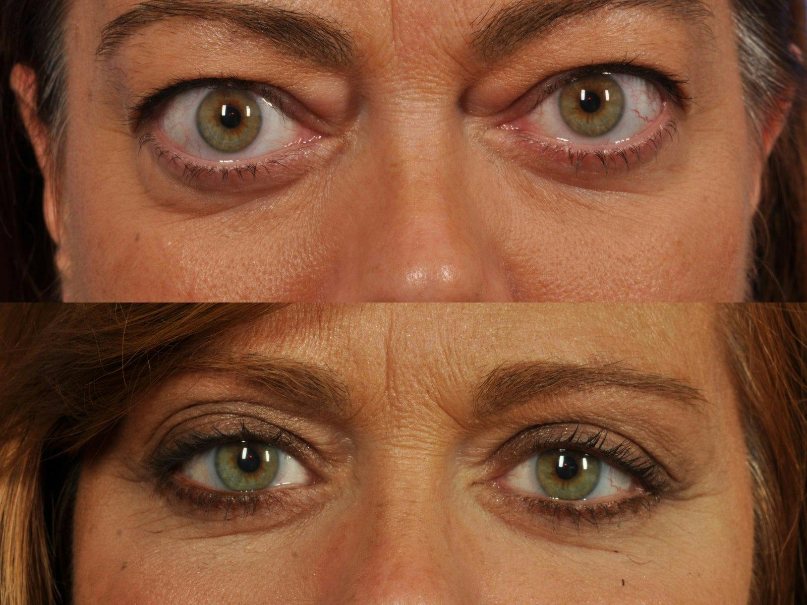 Thyroid Eye Disease Before & After Gallery - Patient 414080 - Image 2