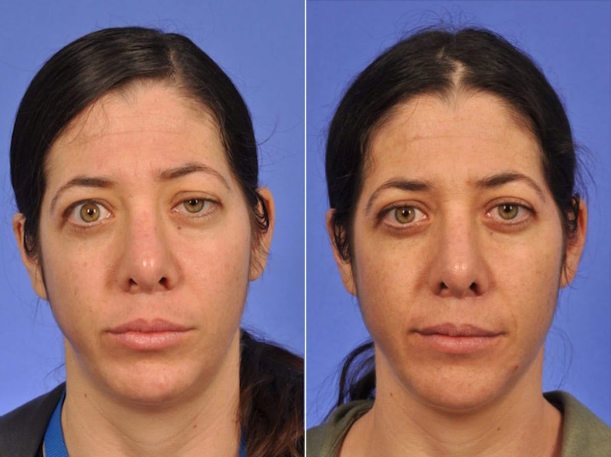 Thyroid Eye Disease Before & After Gallery - Patient 226143 - Image 1