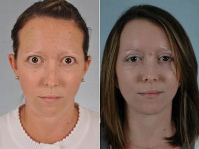Thyroid Eye Disease Before & After Gallery - Patient 183110 - Image 1