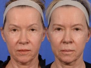 Eyelid Revision Surgery Before & After Gallery - Patient 428980 - Image 1