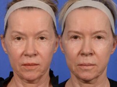 Eyelid Revision Surgery Before & After Gallery - Patient 428980 - Image 1