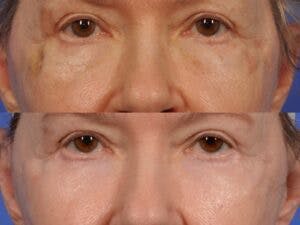 Eyelid Revision Surgery Before & After Gallery - Patient 428980 - Image 2