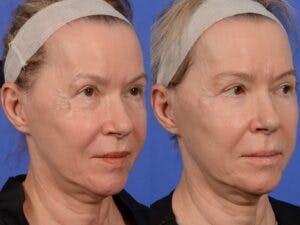 Eyelid Revision Surgery Before & After Gallery - Patient 428980 - Image 3