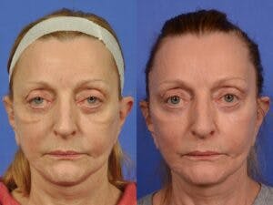 Eyelid Revision Surgery Before & After Gallery - Patient 283185 - Image 1