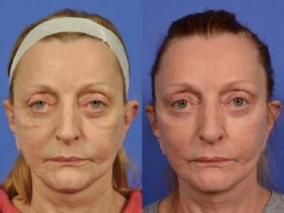 Eyelid Revision Surgery Before & After Gallery - Patient 283185 - Image 1
